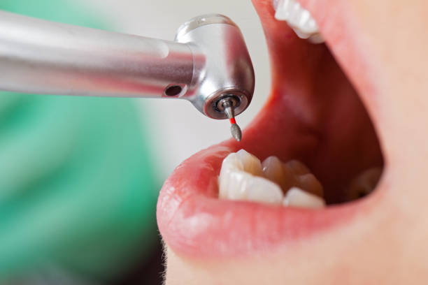 Best Emergency Wisdom Teeth Removal in Gamewell, NC